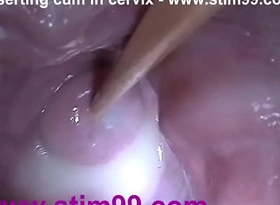 Flier sex cream cum adjacent to cervix nigh dilatation cookie speculum